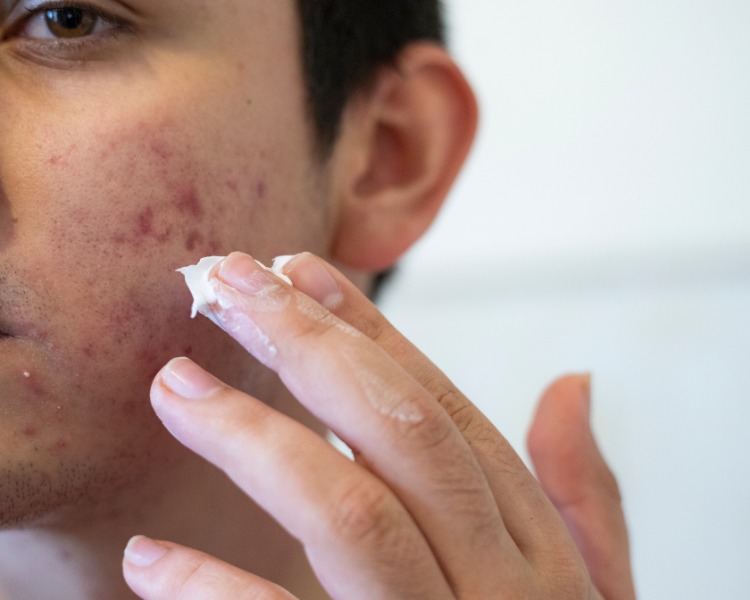 Acne Hombre