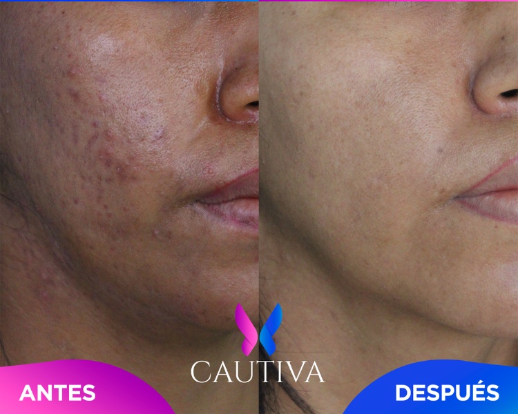 Facial-Secuelas de Acne