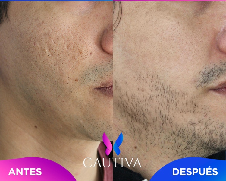 Facial-Secuelas de Acne (3)